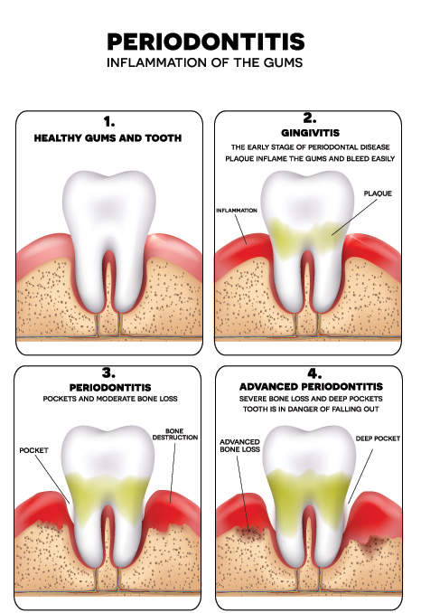 Causes Of Sudden Gum Bleeding