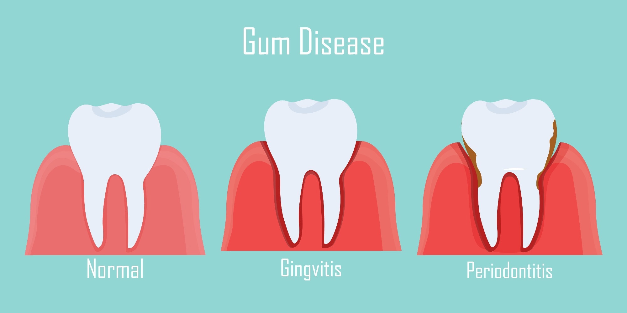 Causes Of Sudden Gum Bleeding