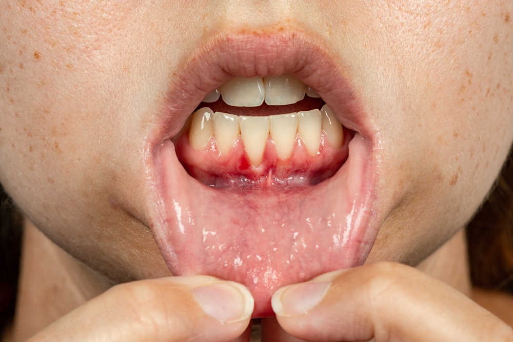 Fastest Ways To Treat A Gum Infection