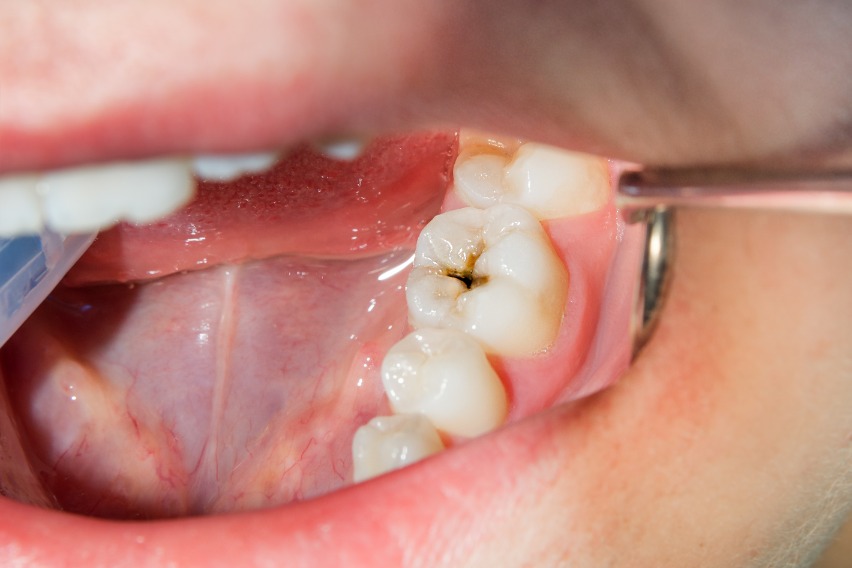 Is It Advisable To Leave A Decayed Tooth Untreated