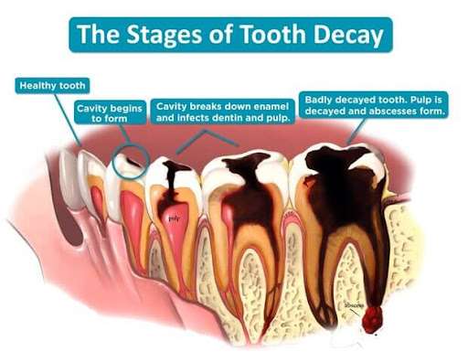 Is It Advisable To Leave A Decayed Tooth Untreated