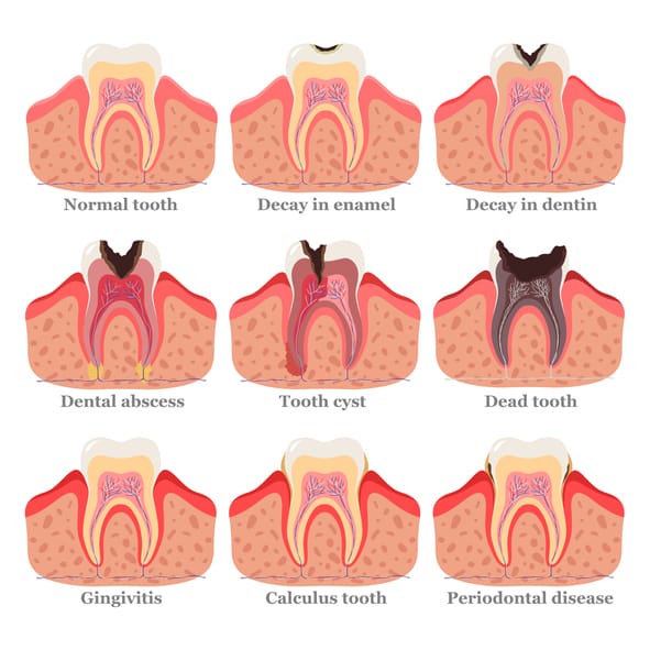 Is It Advisable To Leave A Decayed Tooth Untreated