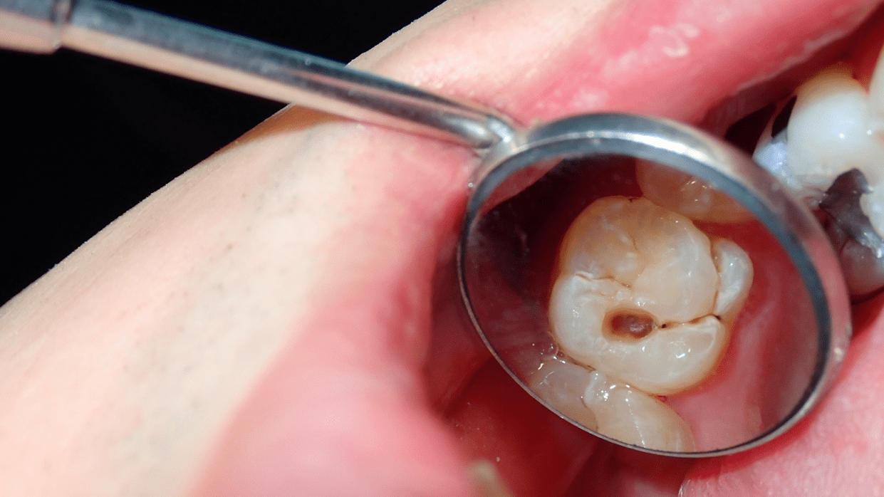 Is It Advisable To Leave A Decayed Tooth Untreated