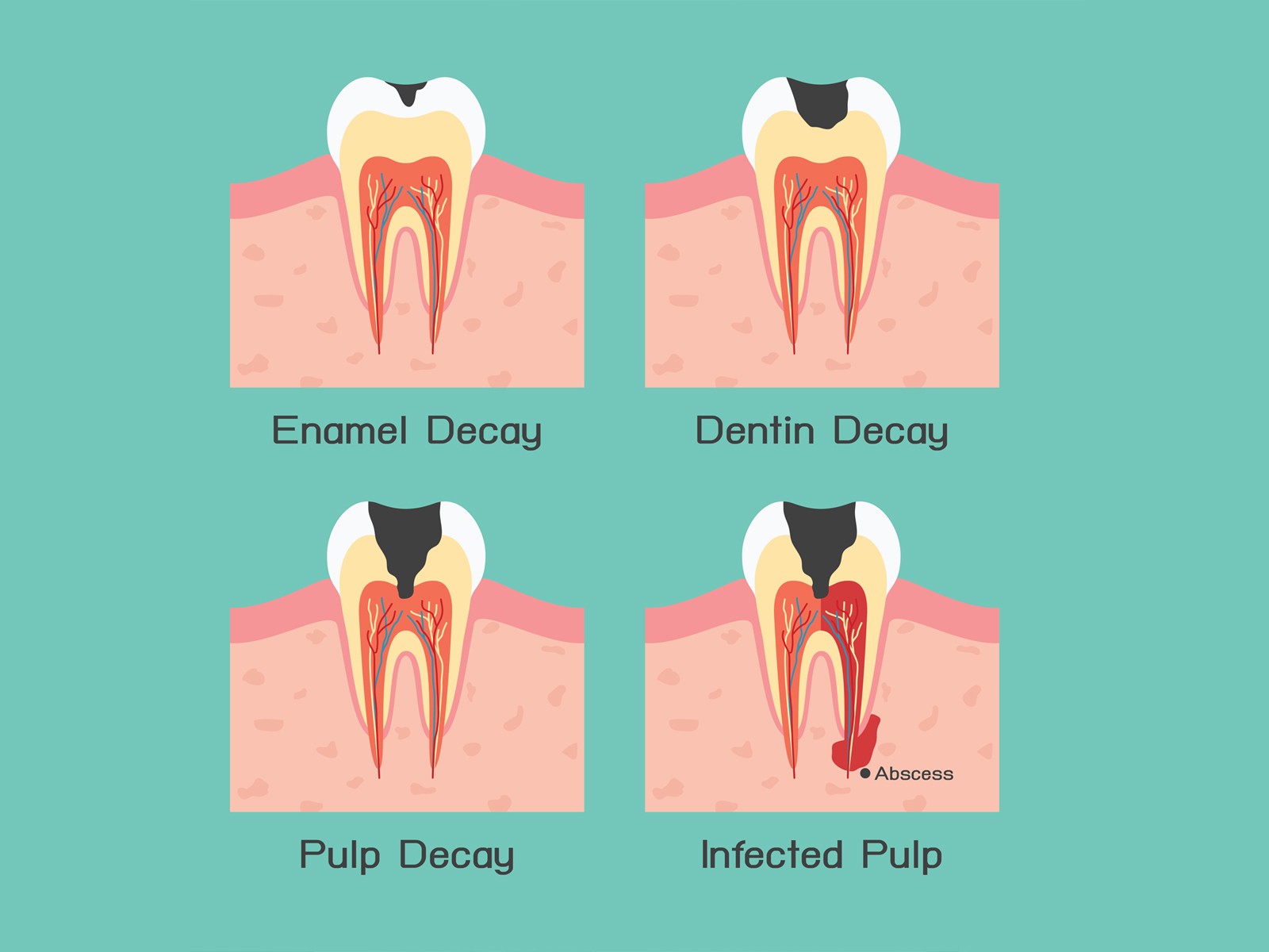 Saving A Decaying Tooth With Effective Treatment