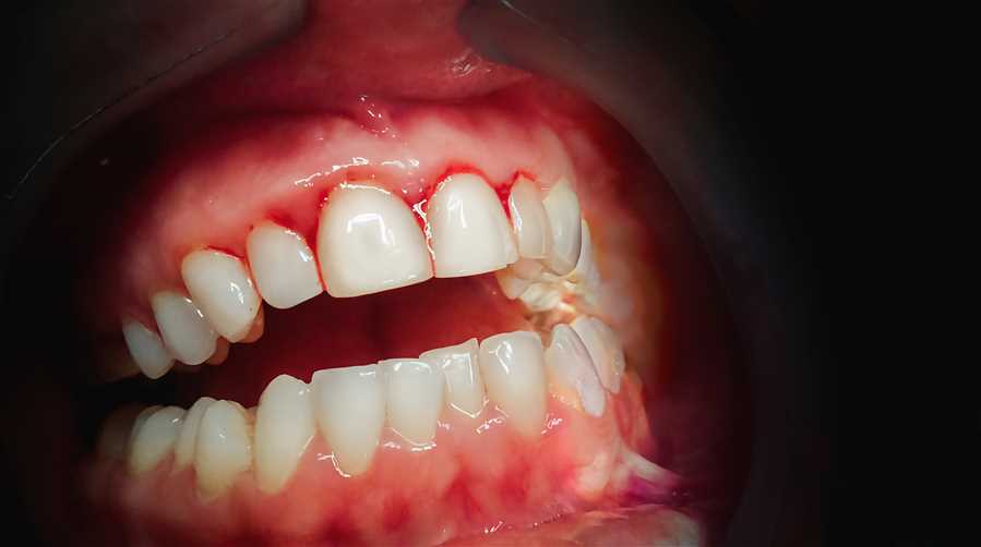 Should I Continue Brushing If My Gums Are Bleeding?