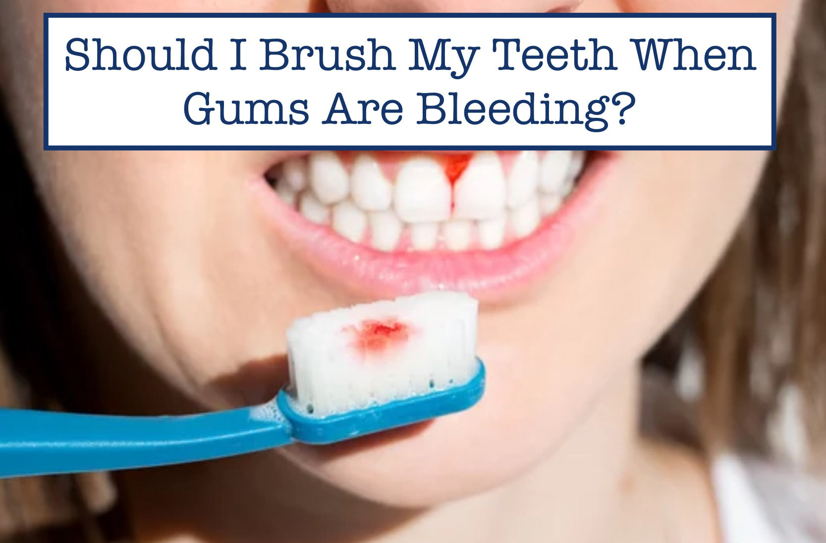 Should I Continue Brushing If My Gums Are Bleeding?