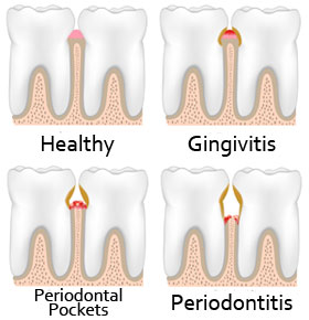 Should I Continue Brushing If My Gums Are Bleeding?