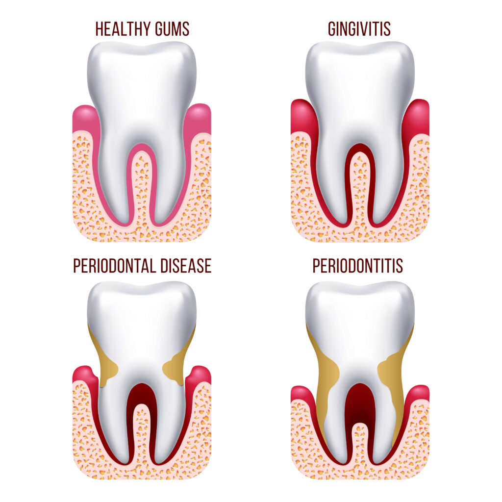 Should I Continue Brushing If My Gums Are Bleeding?