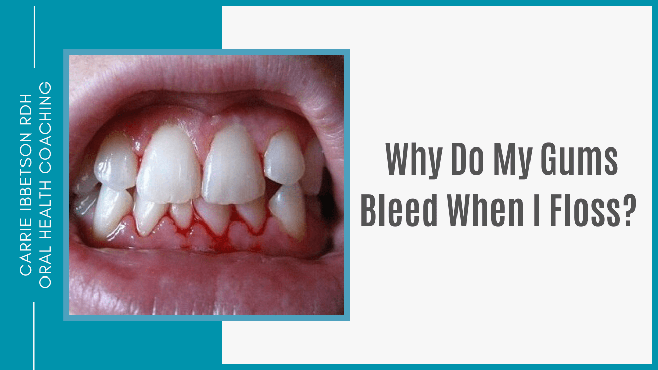 Should I Continue Brushing If My Gums Are Bleeding?